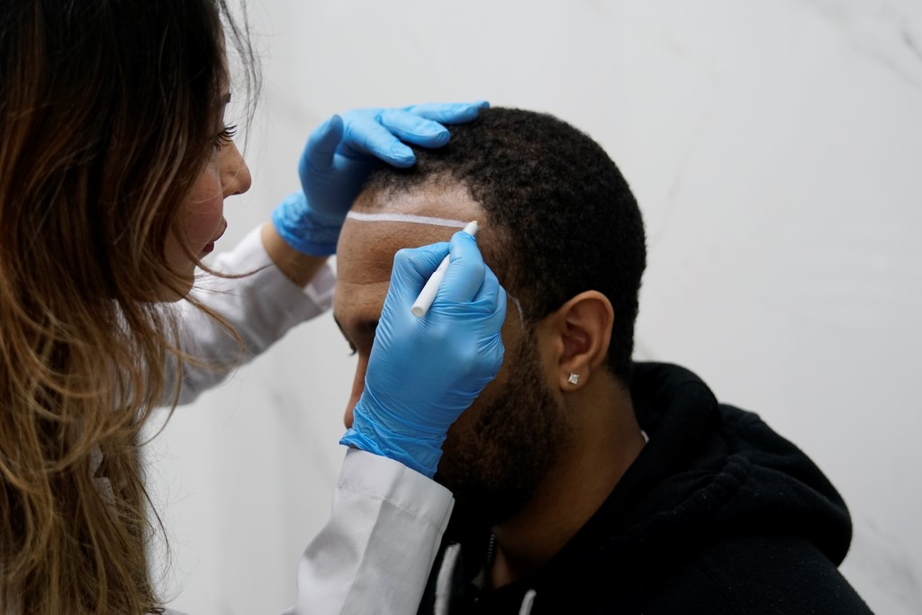 🌟 Afro Haartransplantatie in Turkije – Natuurlijke & Permanente Resultaten