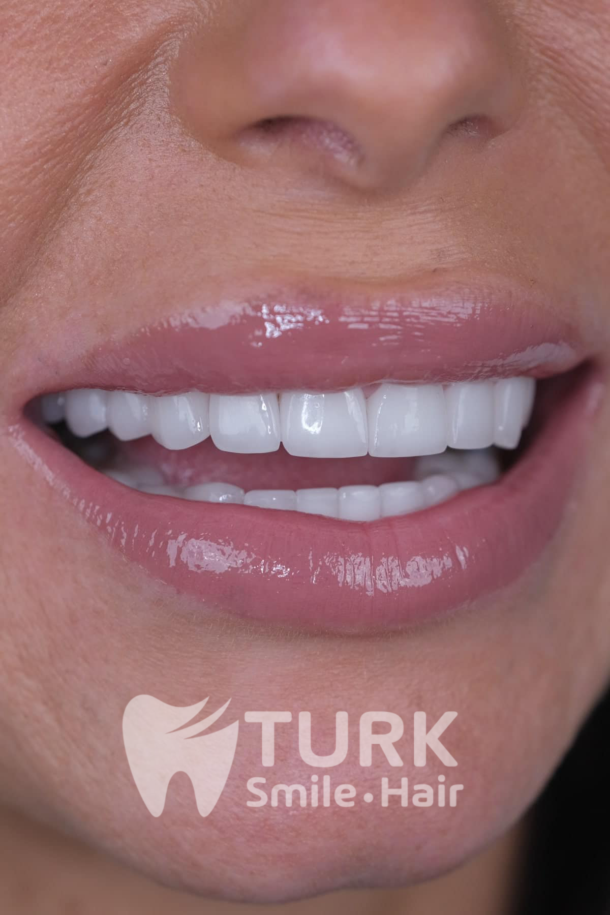 🦷 Affordable & High-Quality Dental Crowns in Turkey – Turk Smile Hair 🇹🇷