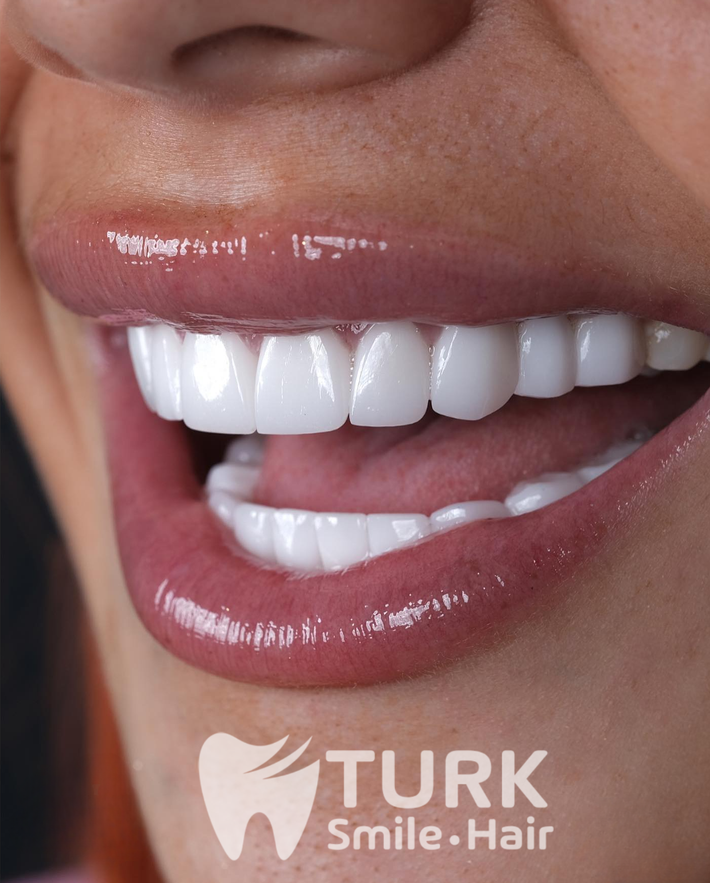 🌟 Hollywood Smile in Turkey – Get Your Dream Smile Today! 🌟