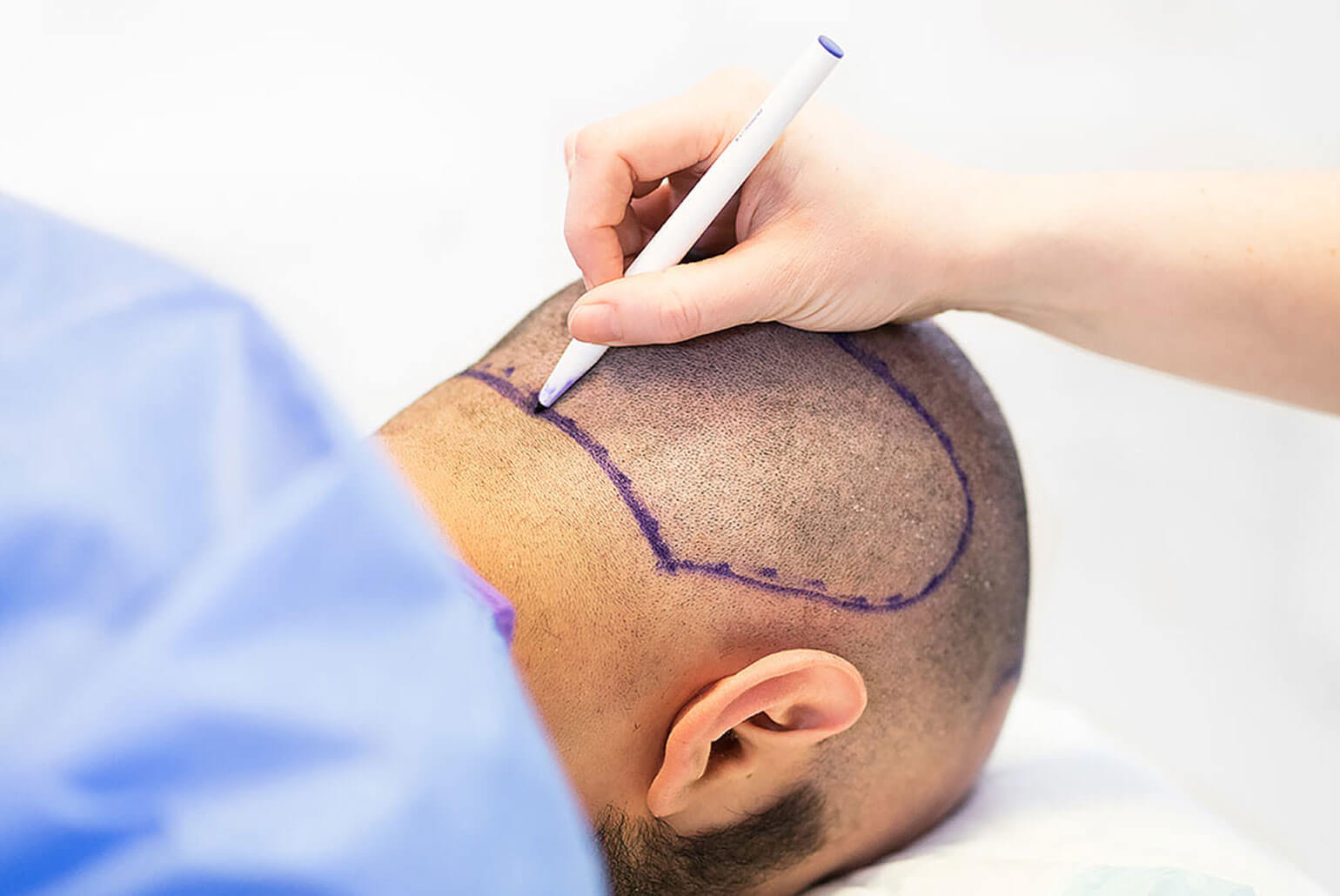 ✨ Sapphire FUE Haartransplantatie in Turkije: De Ultieme Oplossing voor Natuurlijk Haarherstel ✨